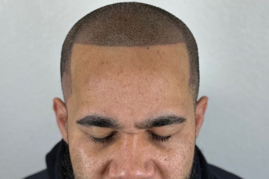 Client with a freshly built SMP hairline, front view